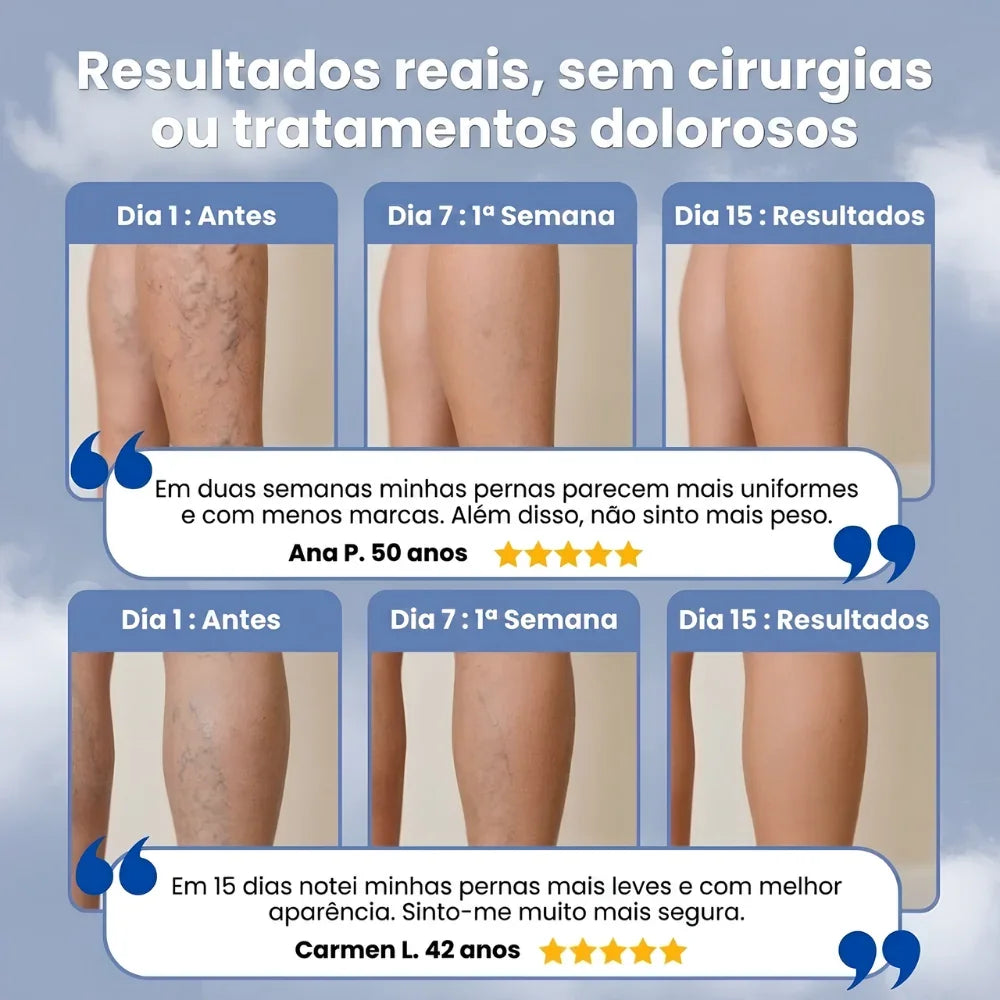 VariVeins™ - Volta a Ter Pernas Leves Neste Verão
