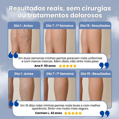 VariVeins™ - Volta a Ter Pernas Leves Neste Verão